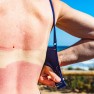 Jak ošetřit kůži spálenou od sluníčka? Pomůžou běžné suroviny